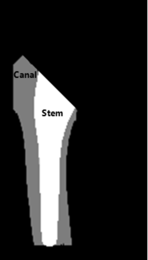 Femur canal fill ratio calculated by regions of canal and stem.