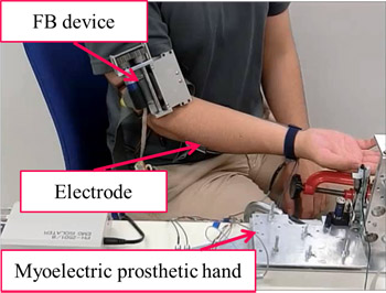 Sensory feedback device for myoelectric hand